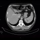 Hamartomas of spleen, hamartoma: CT - Computed tomography